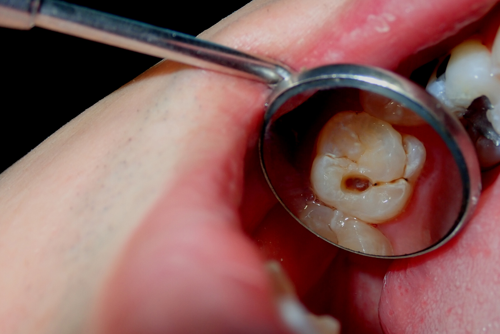 A dental tooth decay cavity found during routine dental examination check up using a dental mirror