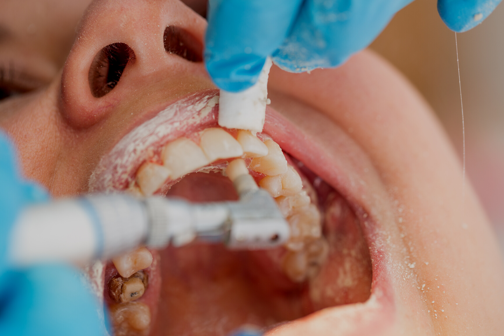 Dental Pumice Cleaning Procedure Close-up